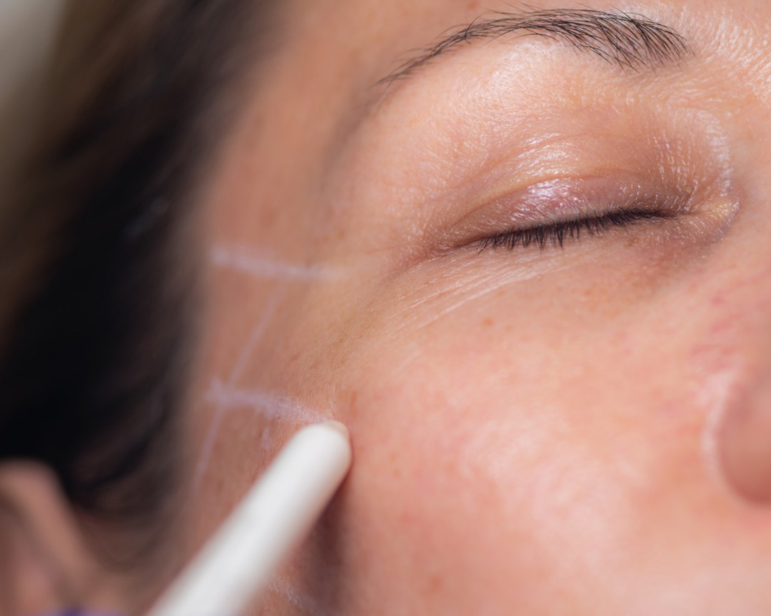 Plasma Skin Treatment at Beauty Worx Ashburton & Christchurch